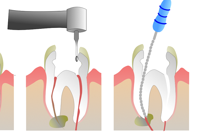 wortelkanaalbehandeling