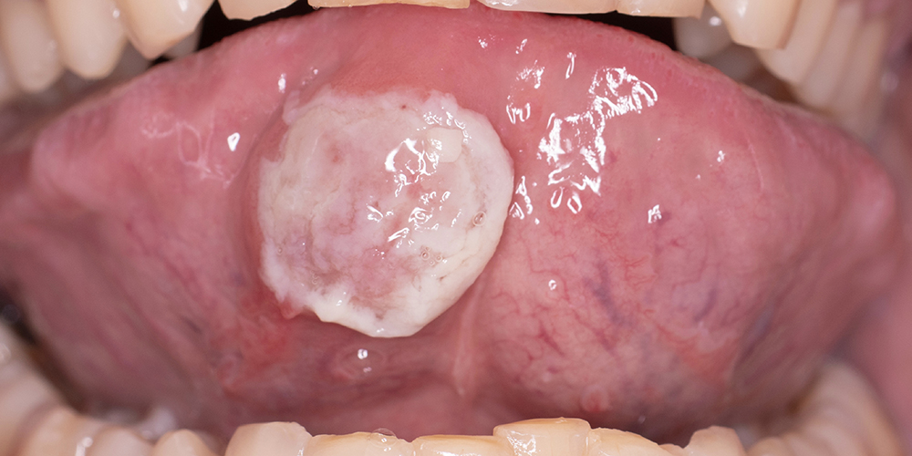 Ulceraties en Erosies van de Mondmucosa