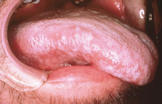 leukoplakie delft