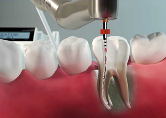 Op de afbeelding is een gedetailleerde doorsnede van een molaar te zien waarbij een roterend endodontisch instrument in het wortelkanaal wordt geleid met behulp van een digitale apexlocator. Deze weergave laat exact zien hoe een wortelkanaalbehandeling effectief ontstekingsweefsel verwijdert en zo de noodzaak tot trekken voorkomt. Het is een treffend voorbeeld van moderne mondzorg en esthetische tandheelkunde waarbij infectiebeheersing en behoud van de natuurlijke tand centraal staan. In de tandartspraktijk spelen nauwkeurige wortelkanaaltechnieken een cruciale rol in het waarborgen van langdurige gebitsverzorging. Dit beeld onderstreept hoe een professionele endodontie bijdraagt aan een gezond, volledig gebit zonder ingrijpende extracties.