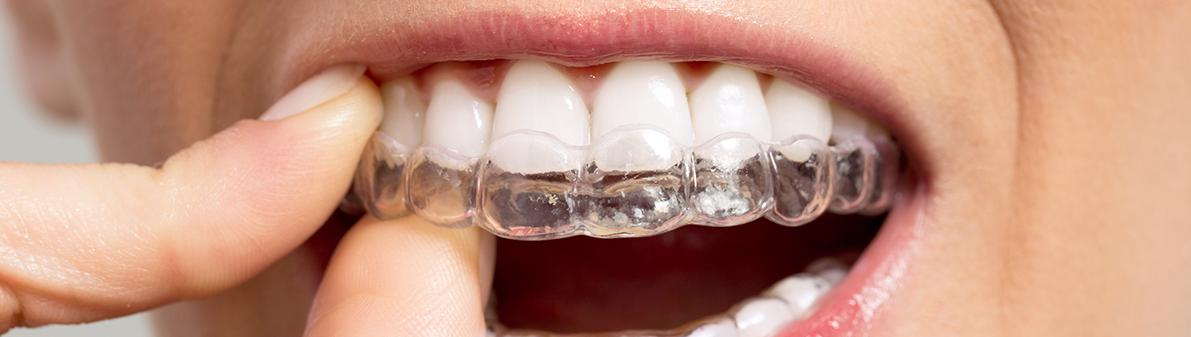 Op de foto zie je een patiënt die een transparante aligner over de tanden schuift, duidelijk vervaardigd als bitje op maat. Dit beeld illustreert hoe in de moderne tandartspraktijk digitale scans en hoogwaardige materialen samenkomen om een perfecte pasvorm te garanderen. Zo’n op maat gemaakt mondbeschermer combineert comfort met optimale gebitsverzorging en speelt een cruciale rol in esthetische tandheelkunde. Het resultaat is een gepersonaliseerd hulpmiddel dat zowel bescherming als een natuurlijk ogende lach ondersteunt.