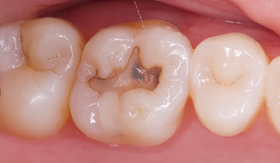 Op de foto is een molaar te zien met een duidelijke cariëslaesie die zowel glazuur als dentine heeft doorbroken, omringd door twee gezonde kiezen. Dit beeld onderstreept het belang van professioneel advies cariëspreventie om zuren uit tandplak tijdig te neutraliseren en gaatjesontwikkeling te stoppen. Een goed afgestemd gebitsverzorgingsprogramma met fluoridebehandelingen, poets- en ruittechniek vormt in de tandartspraktijk de basis van effectieve mondzorg. Regelmatige controles en mondzorgadviezen helpen de integriteit van het gebit te behouden en voorkomen ingrijpende restauraties in de esthetische tandheelkunde, zodat een sterk, gezond en stralend gebit binnen handbereik blijft.